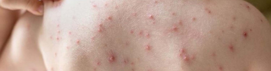 Signs and Symptoms of Monkeypox- Using 17 Dr. Sebi Approved to heal  and Prevent Monkeypox, Other (STDs) Sexually Transmitted Diseases